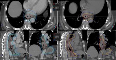 Impact of fiducial markers placement on the delineation of target volumes in radiation therapy for oesophageal cancer: FIDUCOR study